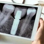 80-YEAR-OLD DERRICK HAD HIS IMPLANTS AT LIKYA DENT